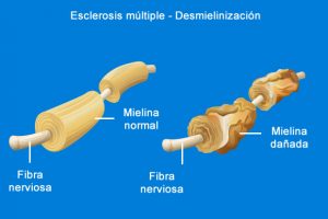 sintomas esclerosis multiple